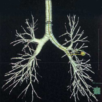 CTによる血管の3D画像