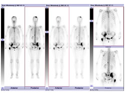 骨シンチ画像